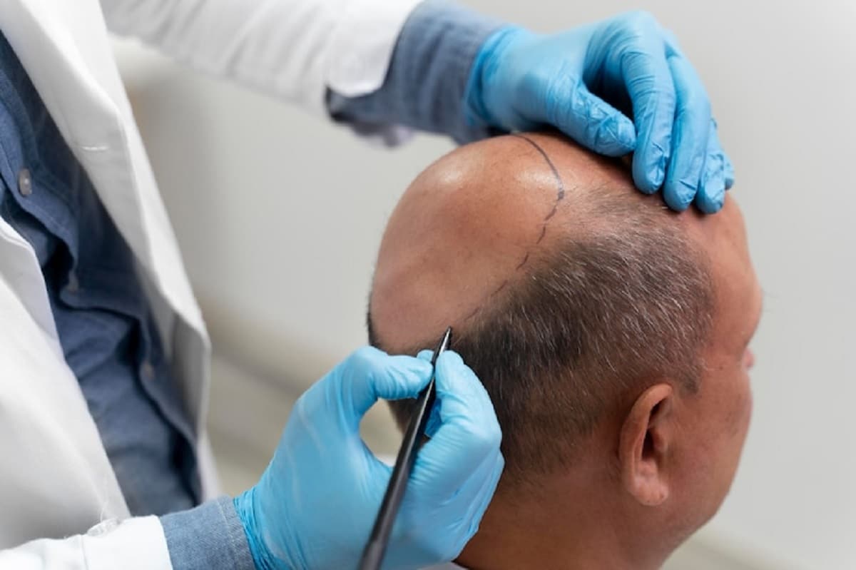 la greffe de cheveux ou les implants capillaires